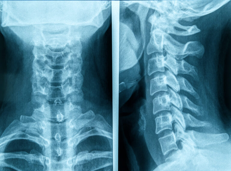 Photo,Of,Human,Neck,X-ray,Image
